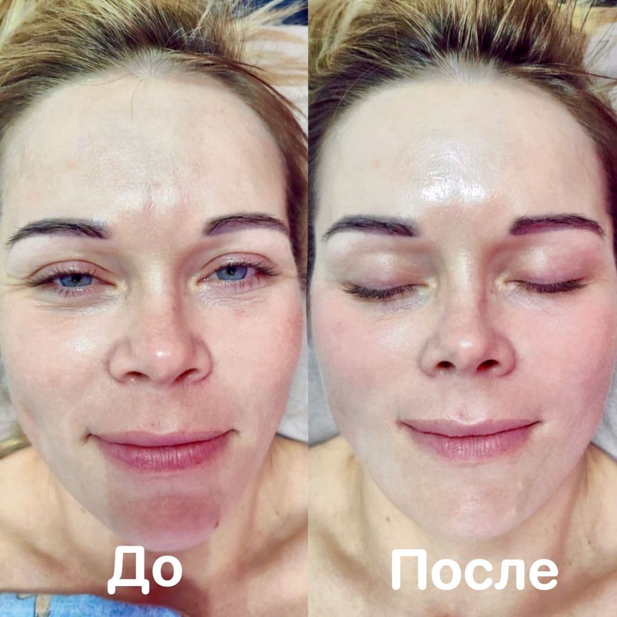 CentrVolkova-kosmeticheskaya-chistka-litsa-al'ginatnaya-maska-do-posle
