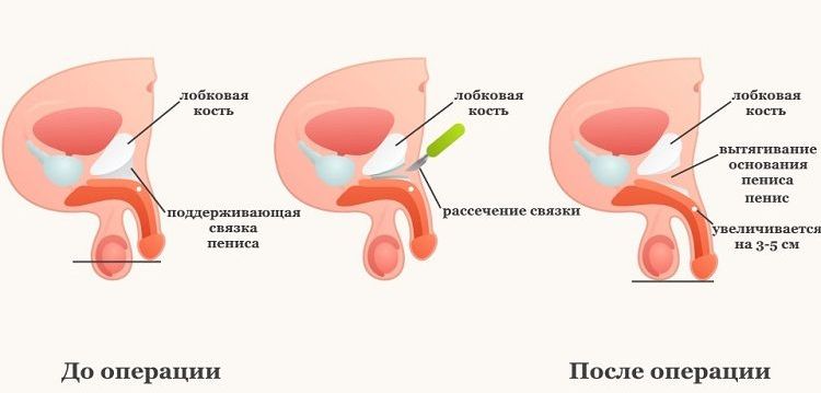 Удлинение полового члена пересечением поддерживающей связки 