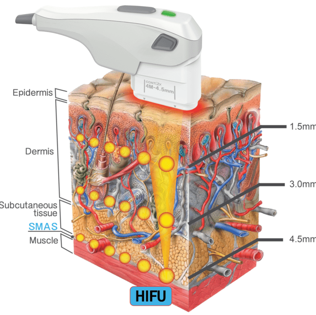 Описание технологии HIFU SMAS-лифтинга